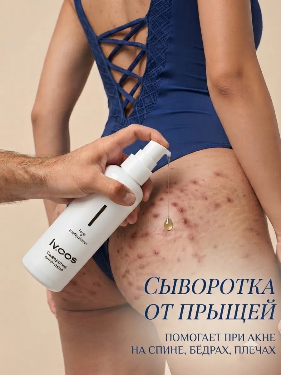 Крем от прыщей на спине сыворотка